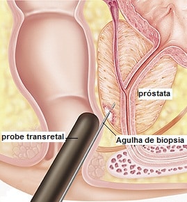 بیوپسی پروستات,سونوگرافی پروستات,Prostate biopsy,نمونه برداری پروستات